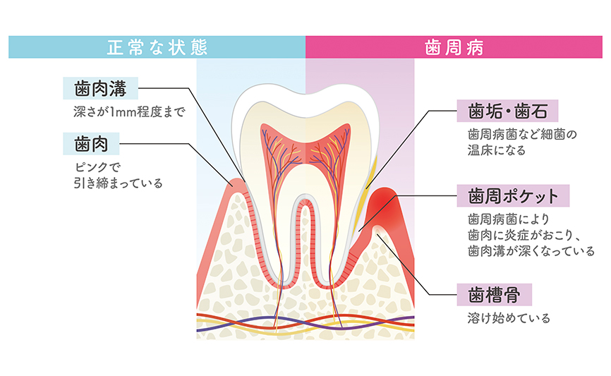 歯周病とは